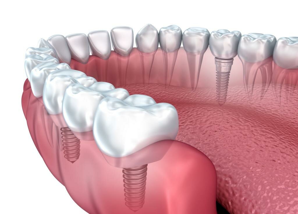 Зубная имплантация и ее главные преимущества