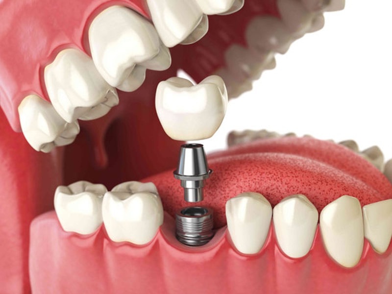 Імплантація зубів – важливий аспект для здорового прикусу