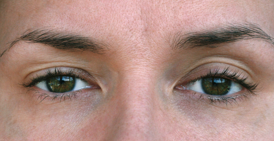 Запалення повіки ока: ознаки та лікування