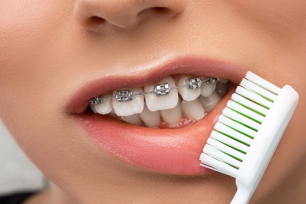 Брекети: їх переваги та ключ для отримання рівних зубів